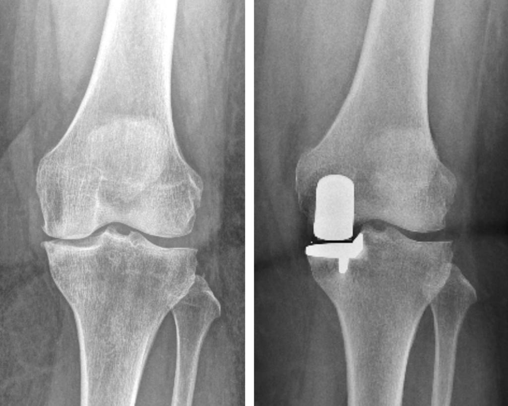 protesi ginocchio monocompartimentale